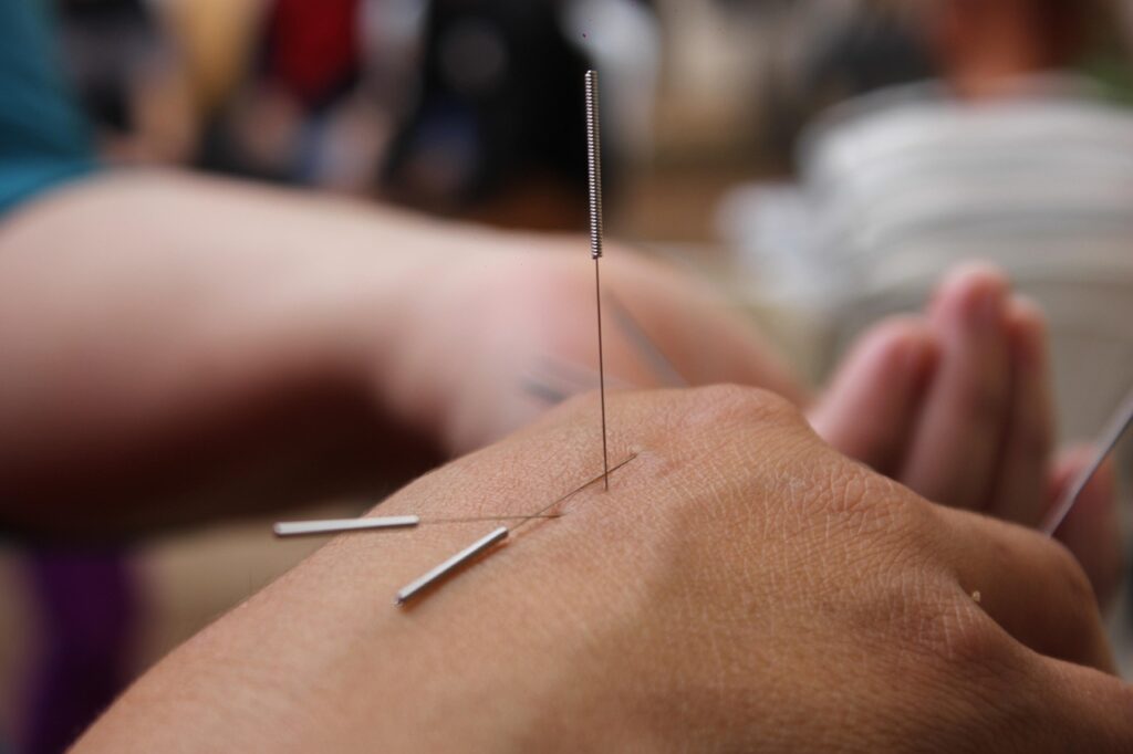 Nosotros Acupuntura Mareca Girona acupuncture, needles, hand, medicine, physiotherapy, therapy, traditional, wellness, skin, spa, closeup, acupuncture, acupuncture, acupuncture, acupuncture, acupuncture